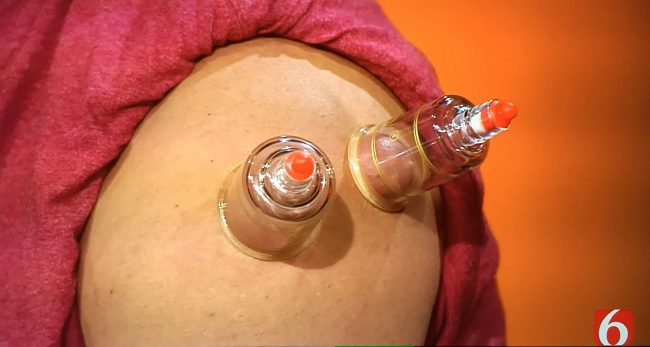 Cupping, Excel Therapy Oklahoma, Physical Therapy, Ryan Flanary